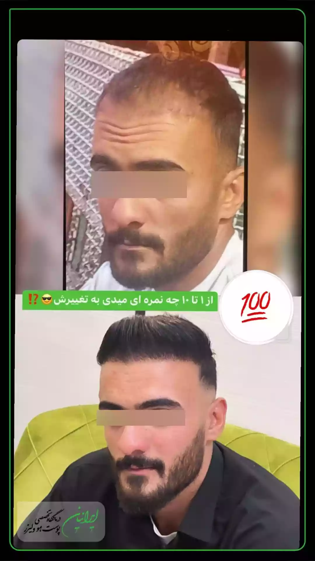 143 کاشت مو