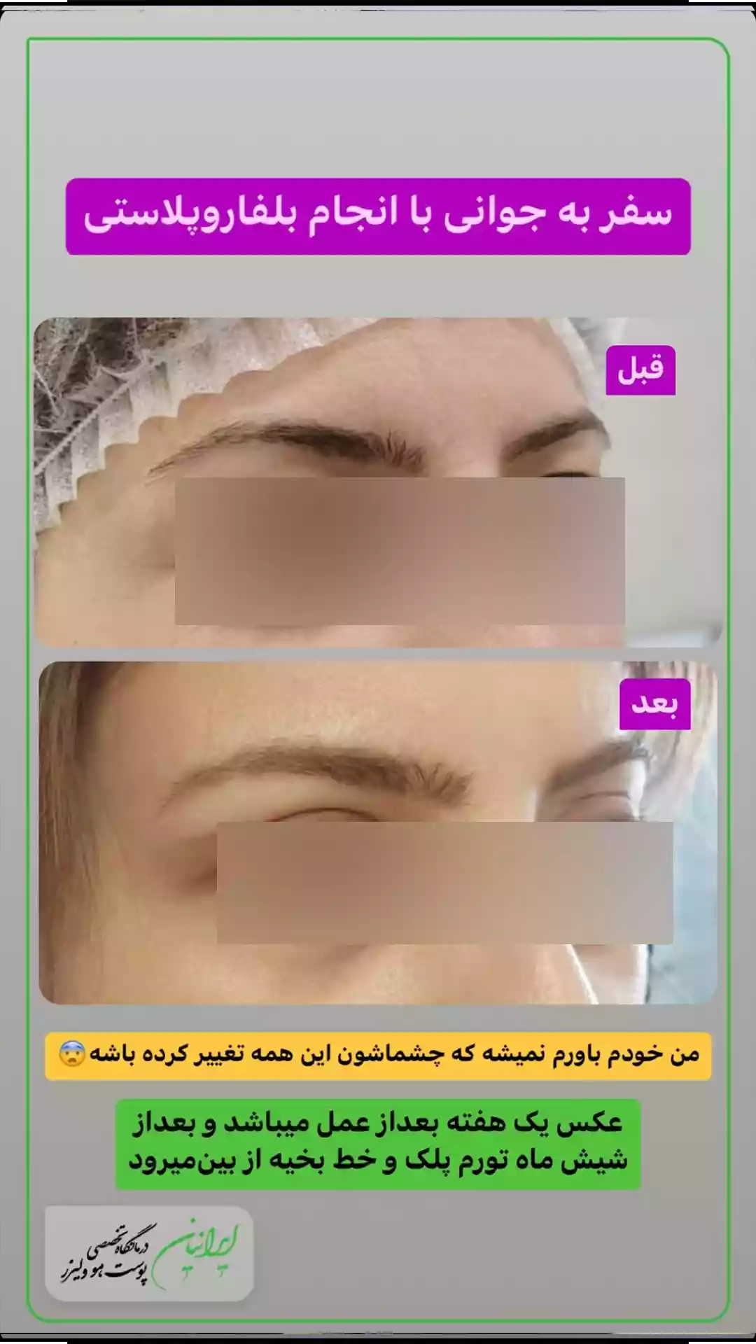 188 بلفاروپلاستی