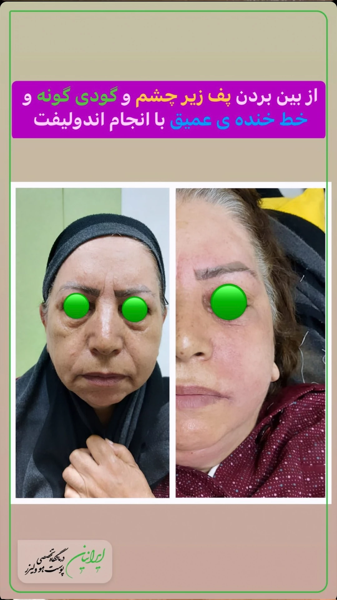 اندولیفت 75