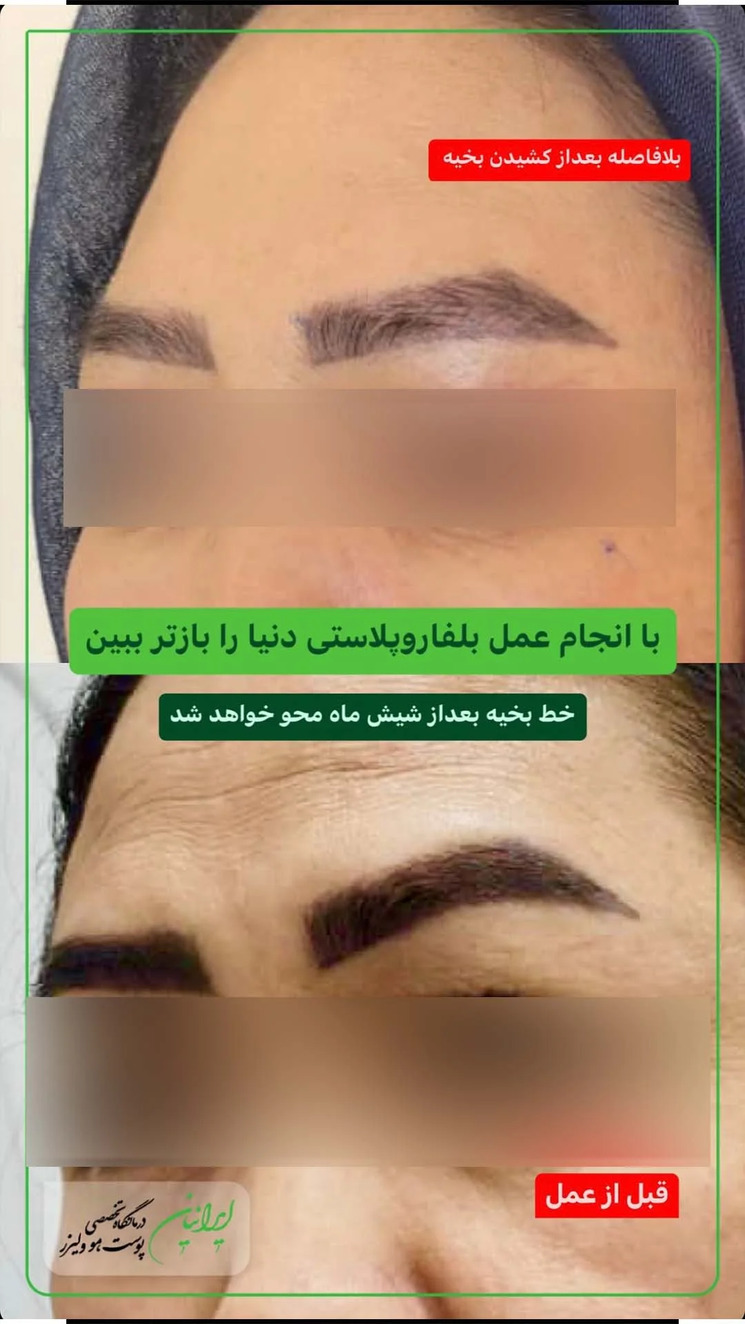 بلفاروپلاستی