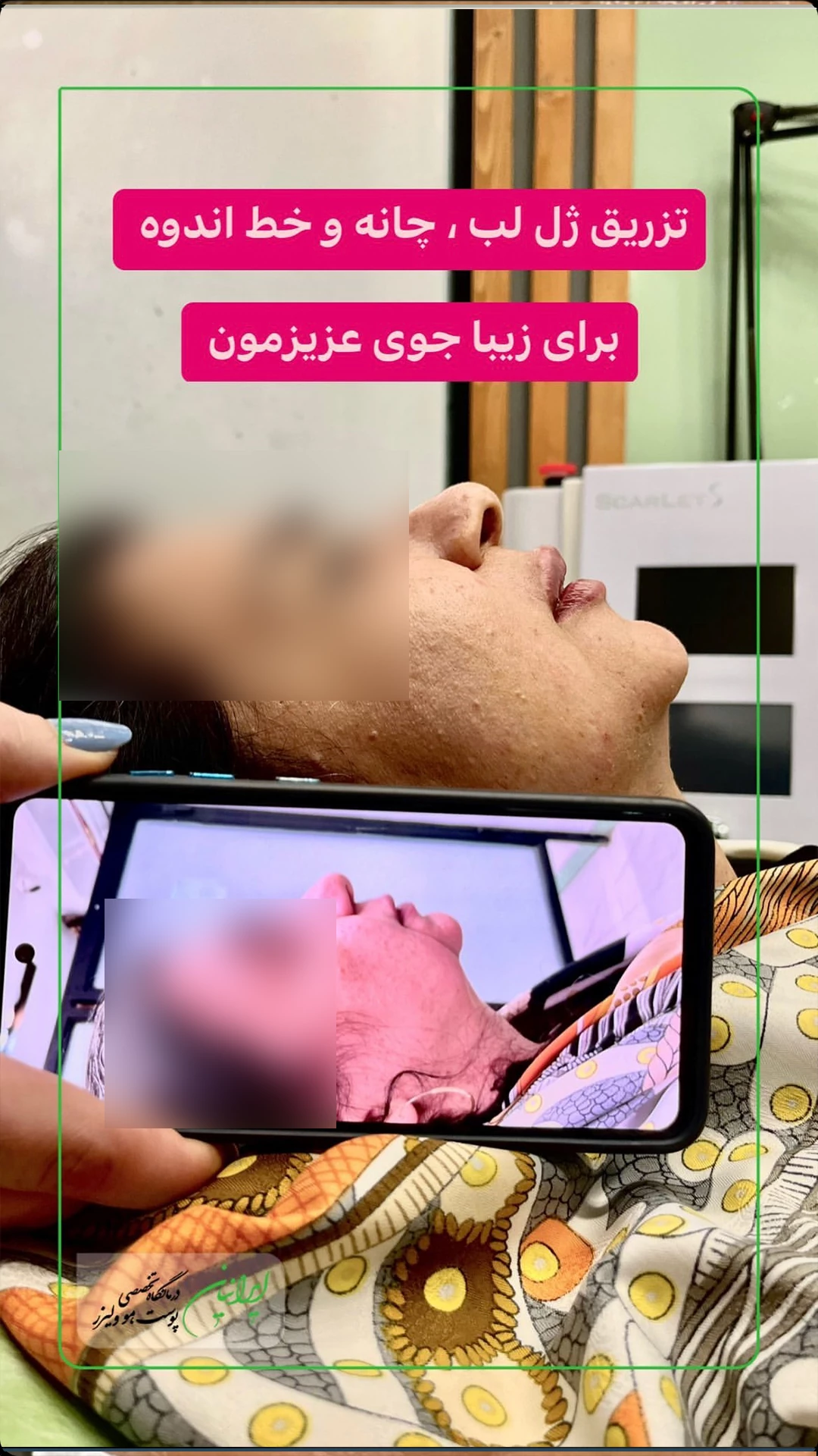 تزریق ژل 101