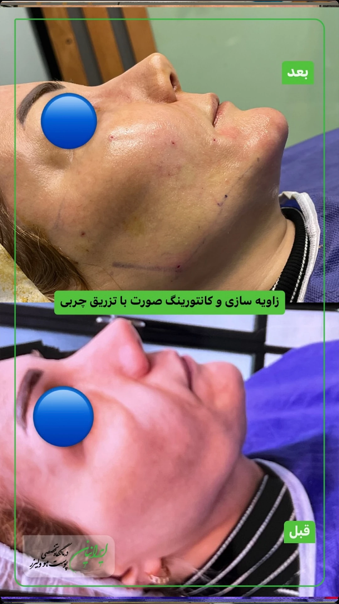زاویه سازی و کانتورینگ صورت 30