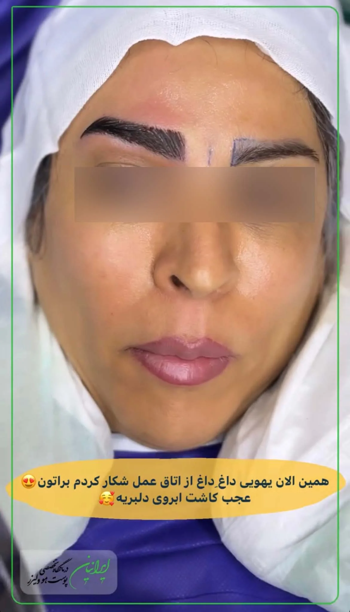 کاشت ابرو 3